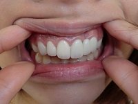 ★歯フェチ写真★23歳差し歯女子の歯 ★歯フェチ写真★23歳差し歯女子の歯