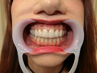 パーフェクトな差し歯お姉さまの歯 パーフェクトな差し歯お姉さまの歯
