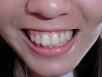 ★歯フェチ写真★高卒OLの歯 ★歯フェチ写真★高卒OLの歯
