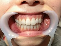 ★歯フェチ写真★矯正済み、メタル系アラサー女子の歯 ★歯フェチ写真★矯正済み、メタル系アラサー女子の歯