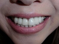 ★歯フェチ写真★総人工歯な美人奥様の歯 ★歯フェチ写真★総人工歯な美人奥様の歯