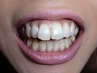 ★歯フェチ写真★ギャル系デリヘルガールの歯の移り変わり ★歯フェチ写真★ギャル系デリヘルガールの歯の移り変わり