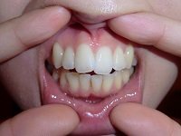 ★歯フェチ写真★21歳【りんごちゃん】の歯 ★歯フェチ写真★21歳【りんごちゃん】の歯