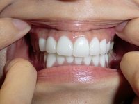 ★歯フェチ写真★アロママッサージのお姉さまの差し歯 ★歯フェチ写真★アロママッサージのお姉さまの差し歯